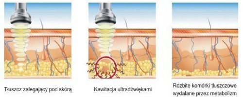 liposukcja_schemat